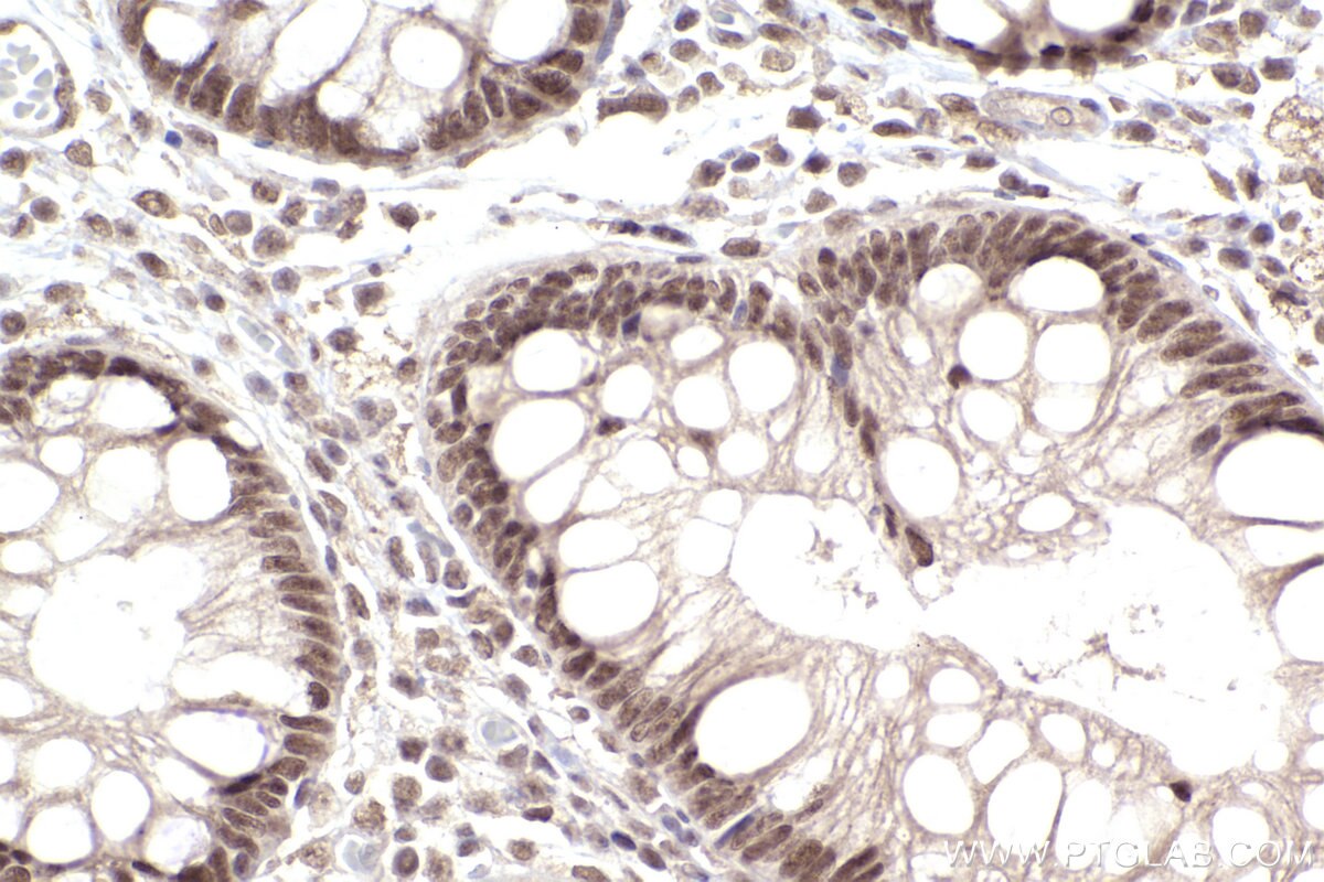 Immunohistochemical analysis of paraffin-embedded human rectal cancer tissue slide using KHC2492 (NCOA2 IHC Kit).