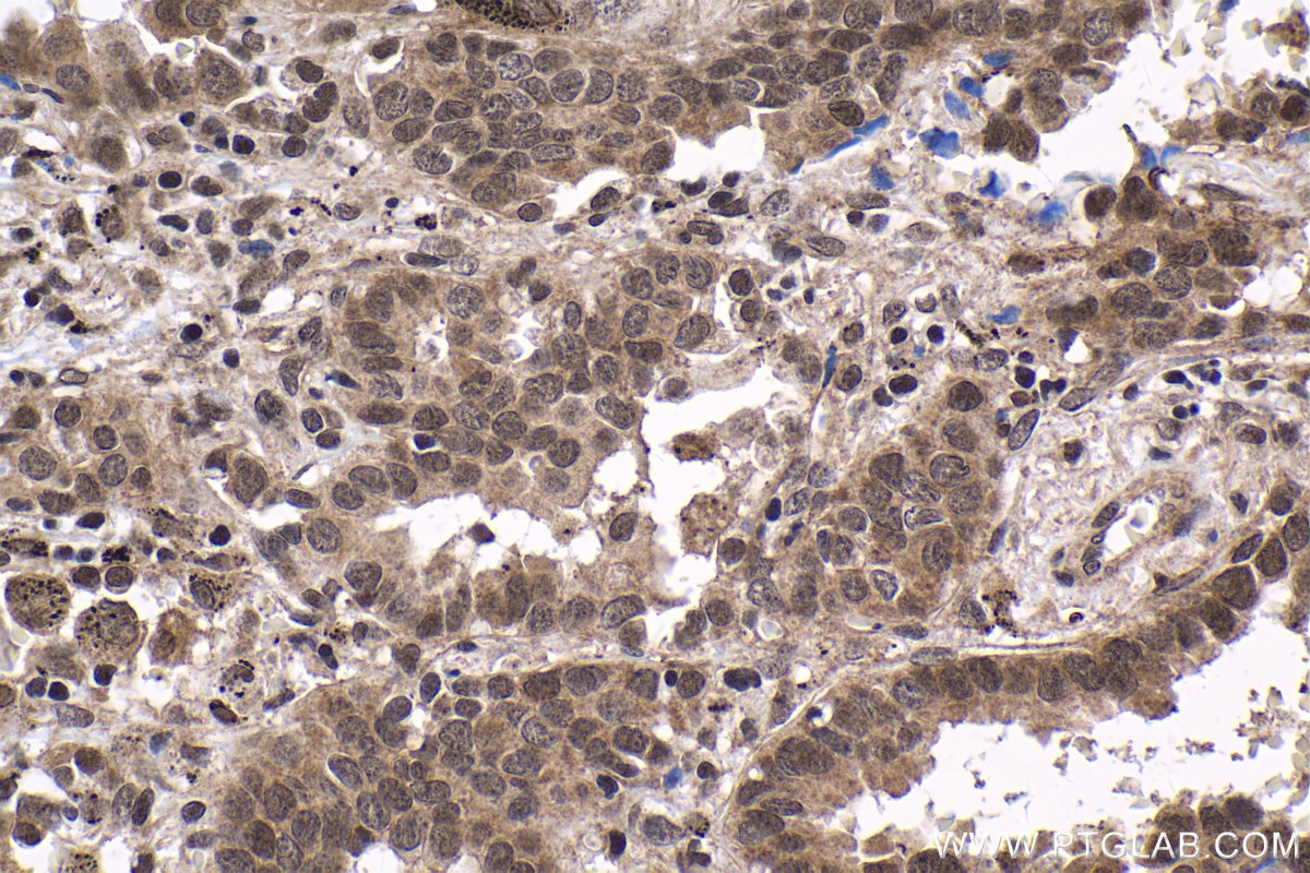 Immunohistochemical analysis of paraffin-embedded human lung cancer tissue slide using KHC1735 (NCOA6 IHC Kit).