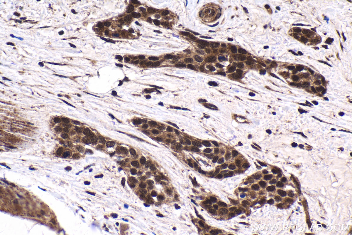 Immunohistochemical analysis of paraffin-embedded human urothelial carcinoma tissue slide using KHC1735 (NCOA6 IHC Kit).