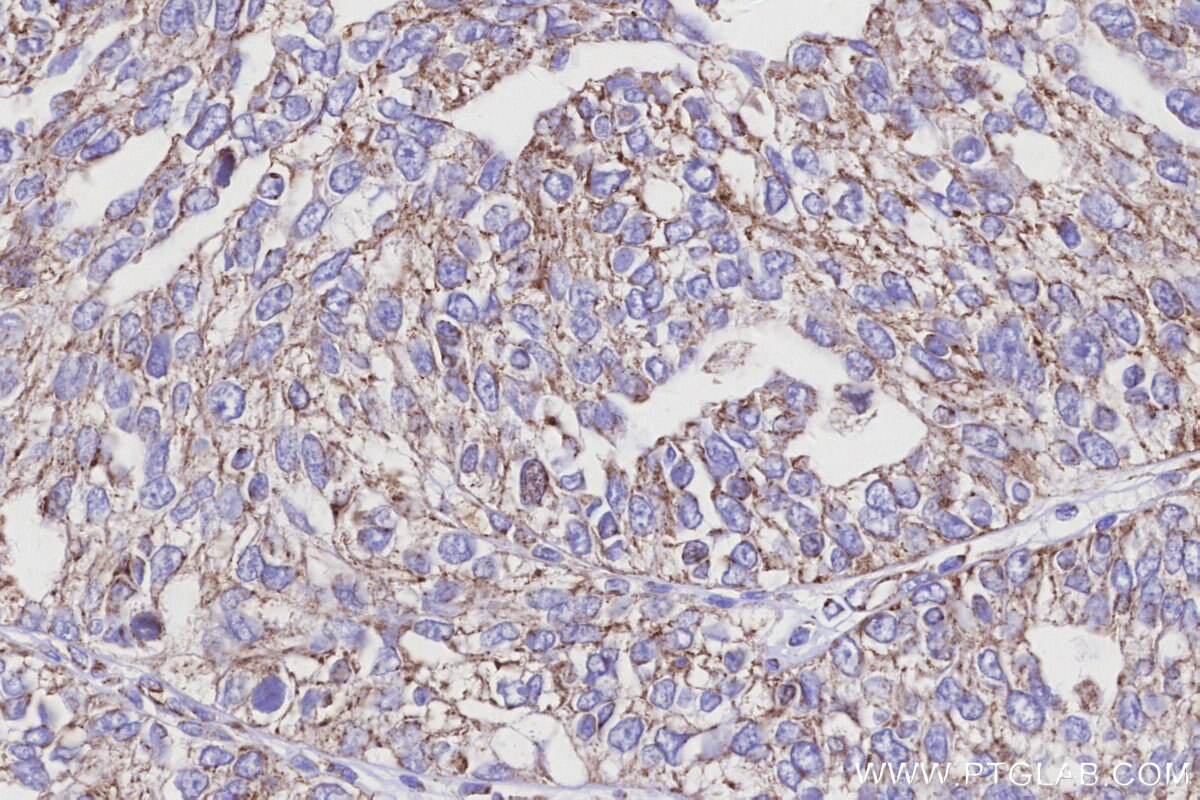 Immunohistochemical analysis of paraffin-embedded human ovary cancer tissue slide using KHC3155 (NDUFA10 IHC Kit). Immunohistochemical analysis of paraffin-embedded human ovary cancer tissue slide using KHC3155 (NDUFA10 IHC Kit).