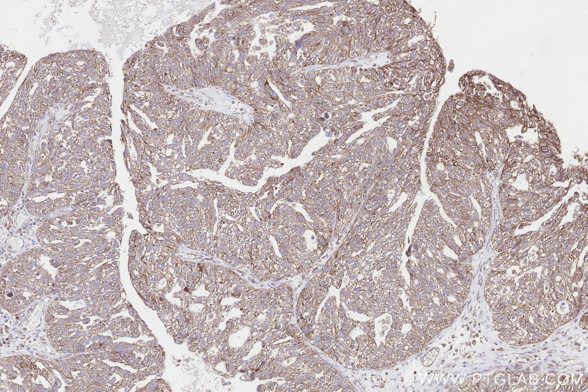 Immunohistochemical analysis of paraffin-embedded human ovary cancer tissue slide using KHC3285 (NDUFA11 IHC Kit). Immunohistochemical analysis of paraffin-embedded human ovary cancer tissue slide using KHC3285 (NDUFA11 IHC Kit).