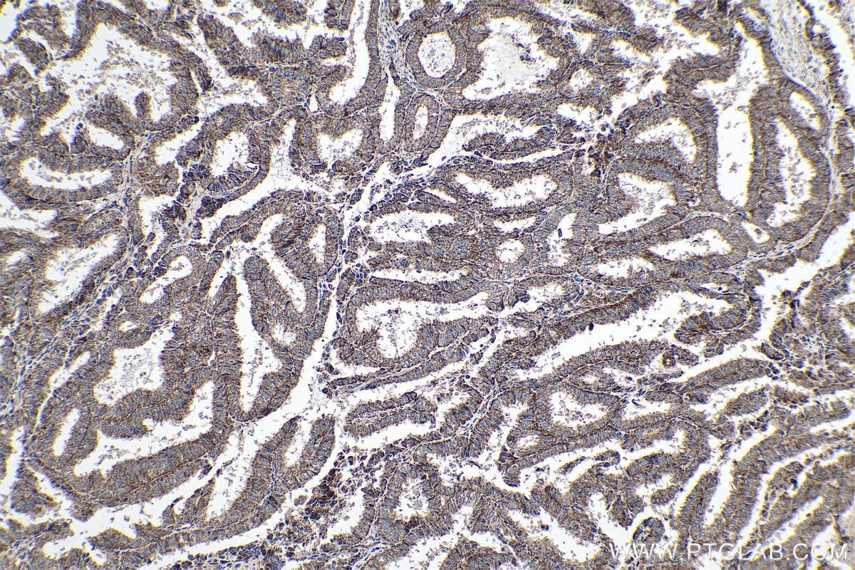 Immunohistochemical analysis of paraffin-embedded human ovary tumor tissue slide using KHC0246 (NDUFA13 IHC Kit).