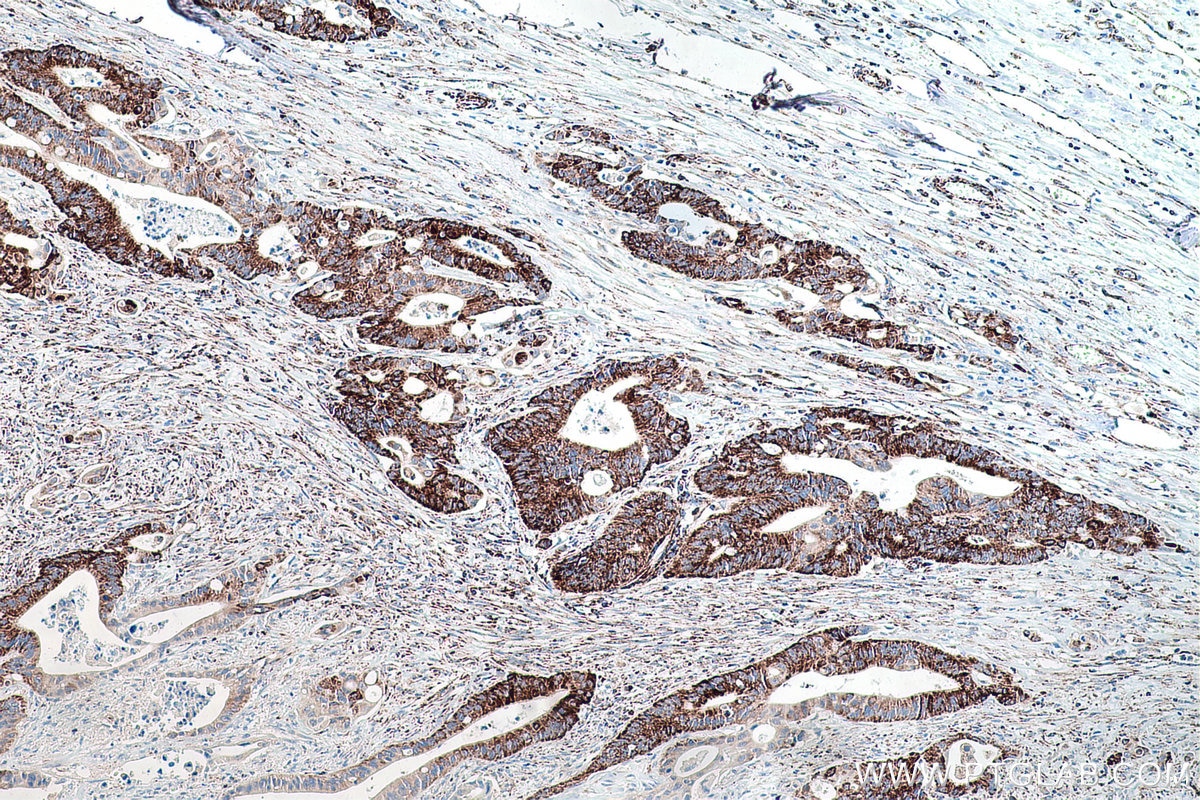 Immunohistochemical analysis of paraffin-embedded human colon cancer tissue slide using KHC0201 (NDUFA4L2 IHC Kit).