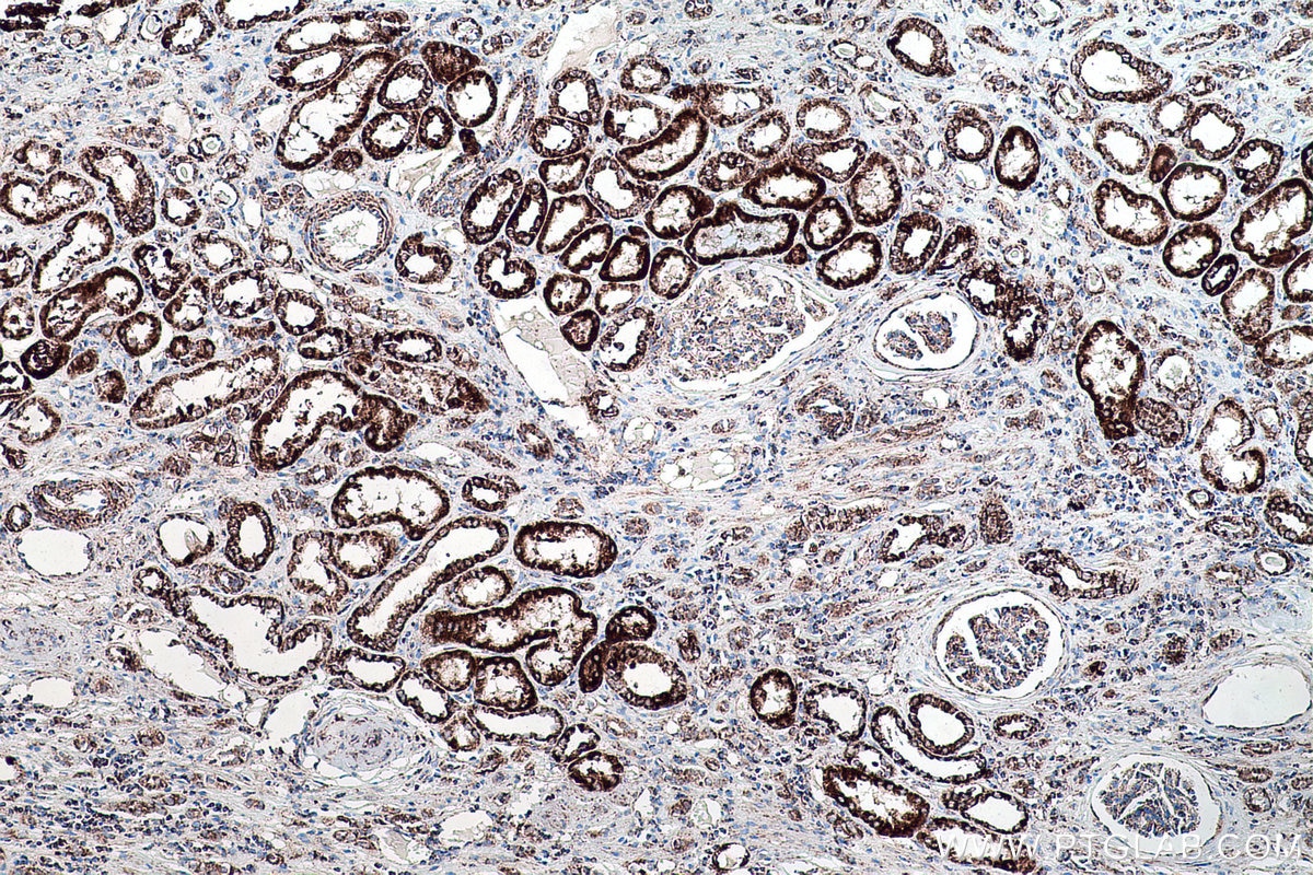 Immunohistochemical analysis of paraffin-embedded human renal cell carcinoma tissue slide using KHC0201 (NDUFA4L2 IHC Kit).