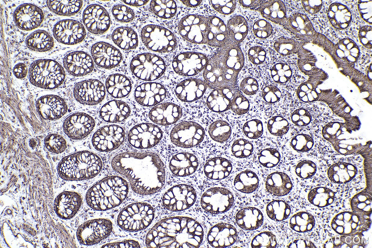 Immunohistochemical analysis of paraffin-embedded human rectal cancer tissue slide using KHC2507 (NDUFA5 IHC Kit).