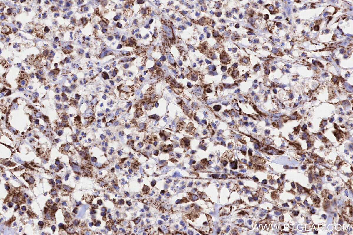 Immunohistochemical analysis of paraffin-embedded human colon cancer tissue slide using KHC3225 (NDUFA8 IHC Kit). Immunohistochemical analysis of paraffin-embedded human colon cancer tissue slide using KHC3225 (NDUFA8 IHC Kit).