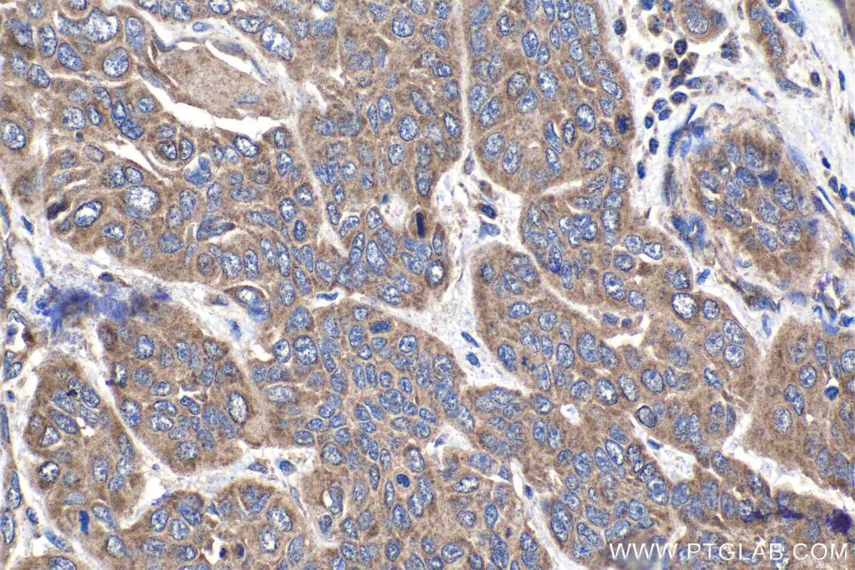 Immunohistochemical analysis of paraffin-embedded human oesophagus cancer tissue slide using KHC1397 (NDUFAF1 IHC Kit).