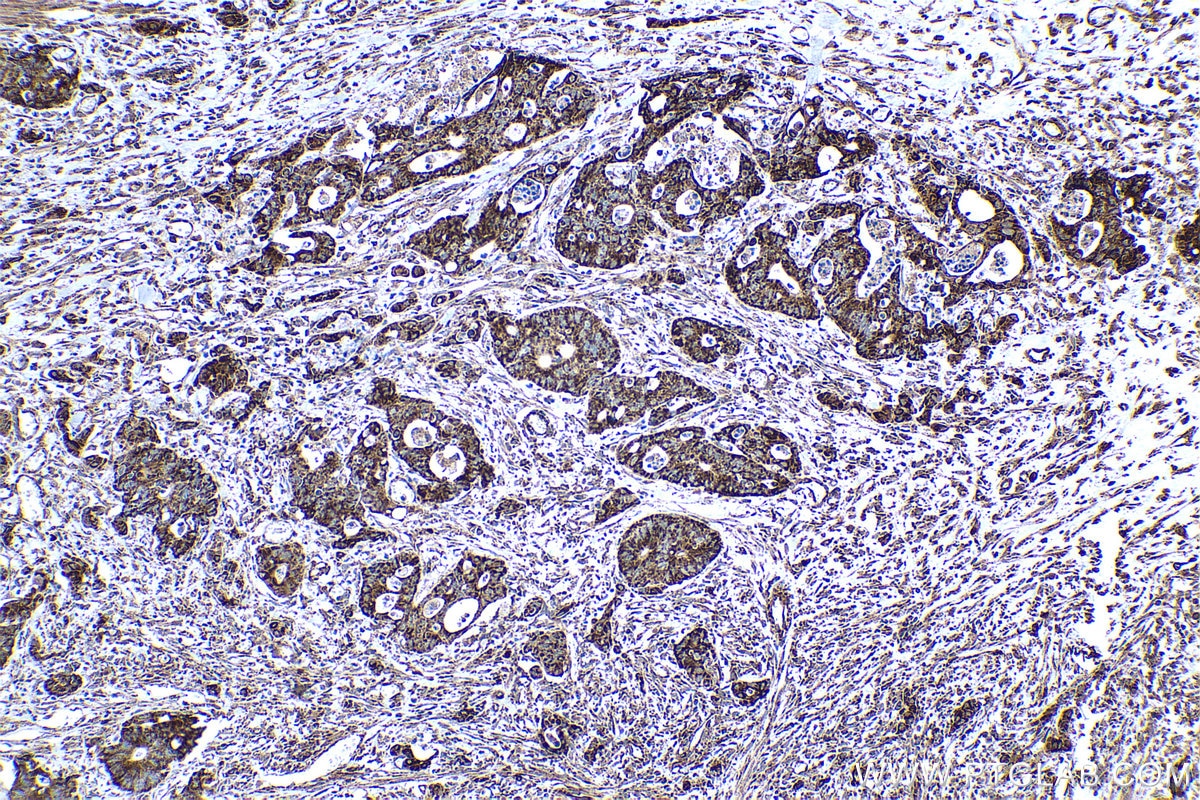 Immunohistochemical analysis of paraffin-embedded human colon cancer tissue slide using KHC0439 (NDUFAF2 IHC Kit).