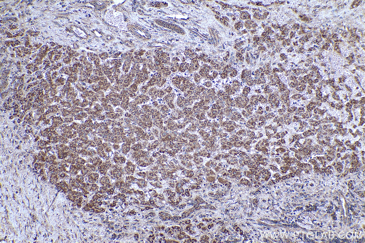 Immunohistochemical analysis of paraffin-embedded human liver cancer tissue slide using KHC0439 (NDUFAF2 IHC Kit).