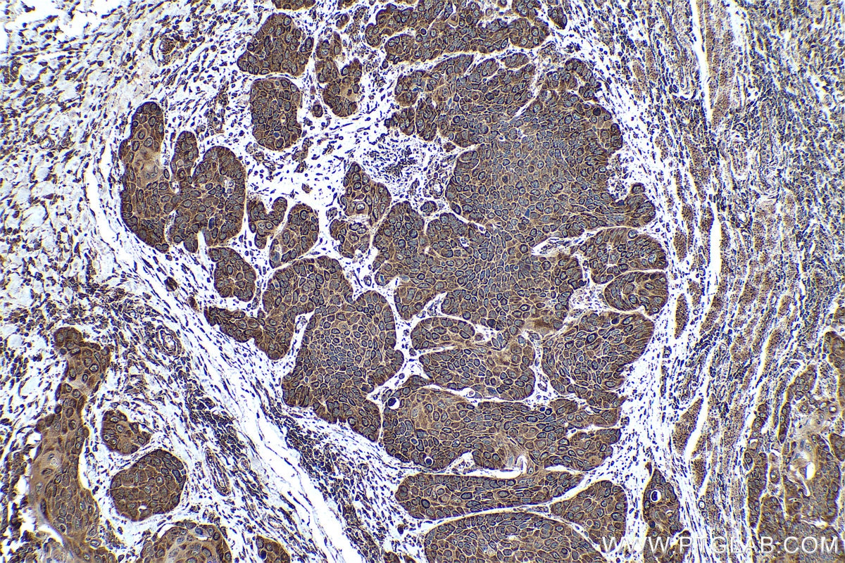 Immunohistochemical analysis of paraffin-embedded human oesophagus cancer tissue slide using KHC0439 (NDUFAF2 IHC Kit).
