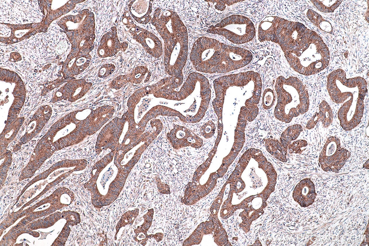 Immunohistochemical analysis of paraffin-embedded human colon cancer tissue slide using KHC0440 (NDUFAF4 IHC Kit).