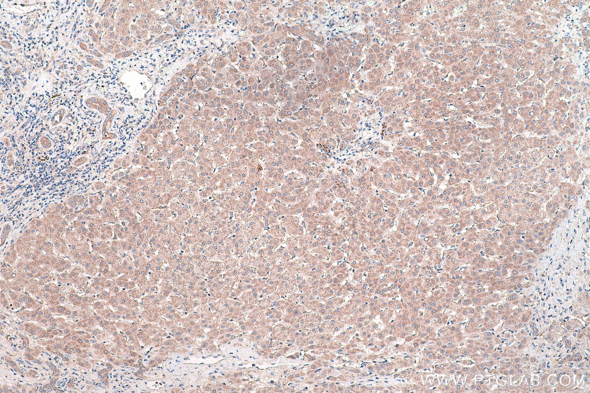 Immunohistochemical analysis of paraffin-embedded human liver cancer tissue slide using KHC0440 (NDUFAF4 IHC Kit).