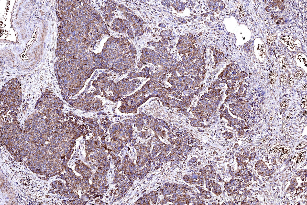 Immunohistochemical analysis of paraffin-embedded human stomach cancer tissue slide using KHC3153 (NDUFB4 IHC Kit).