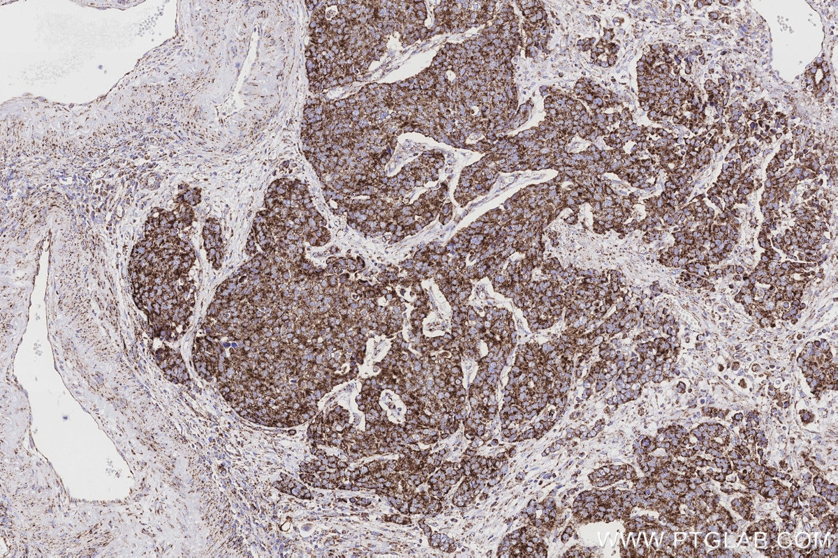 Immunohistochemical analysis of paraffin-embedded human stomach cancer tissue slide using KHC3193 (NDUFB7 IHC Kit). Immunohistochemical analysis of paraffin-embedded human stomach cancer tissue slide using KHC3193 (NDUFB7 IHC Kit).