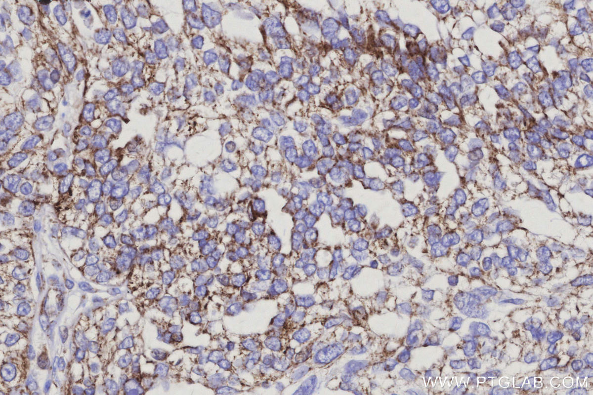 Immunohistochemical analysis of paraffin-embedded human ovary cancer tissue slide using KHC3146 (NDUFS5 IHC Kit).
