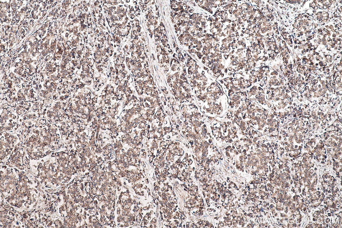 Immunohistochemical analysis of paraffin-embedded human colon cancer tissue slide using KHC0633 (NDUFV1 IHC Kit).