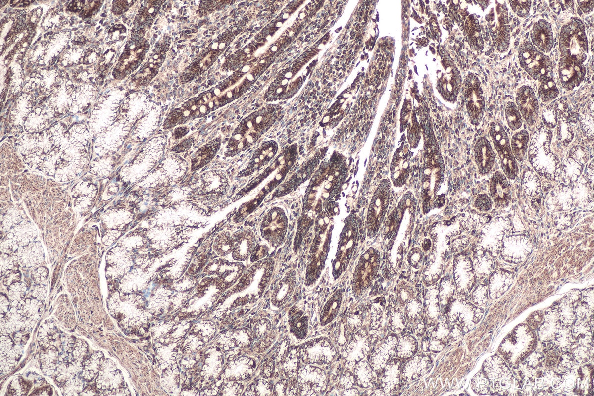 Immunohistochemical analysis of paraffin-embedded human stomach cancer tissue slide using KHC0633 (NDUFV1 IHC Kit).