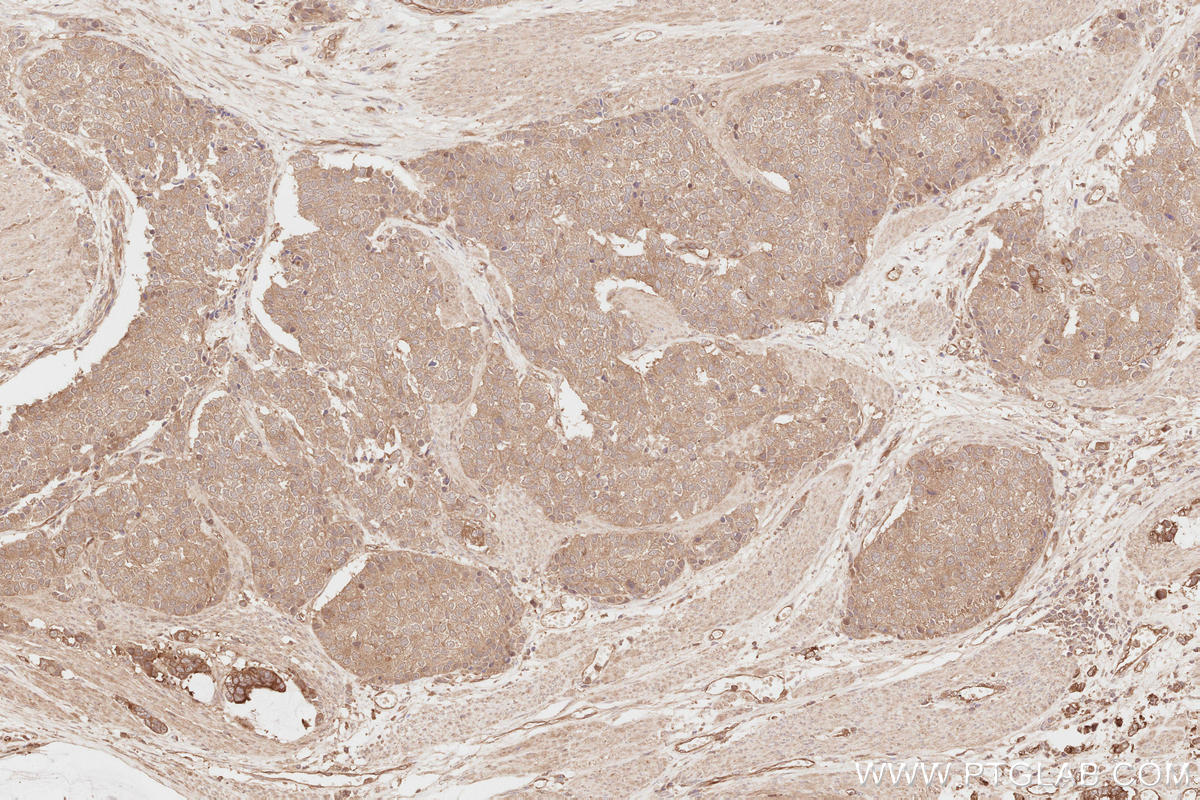 Immunohistochemical analysis of paraffin-embedded human stomach cancer tissue slide using KHC2815 (NEDD4L IHC Kit).