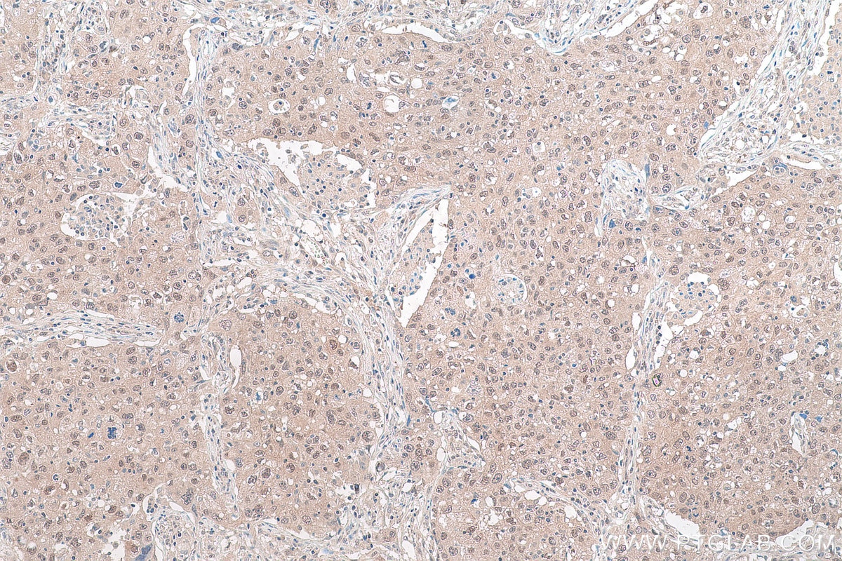 Immunohistochemical analysis of paraffin-embedded human lung cancer tissue slide using KHC0901 (NEDD8 IHC Kit).