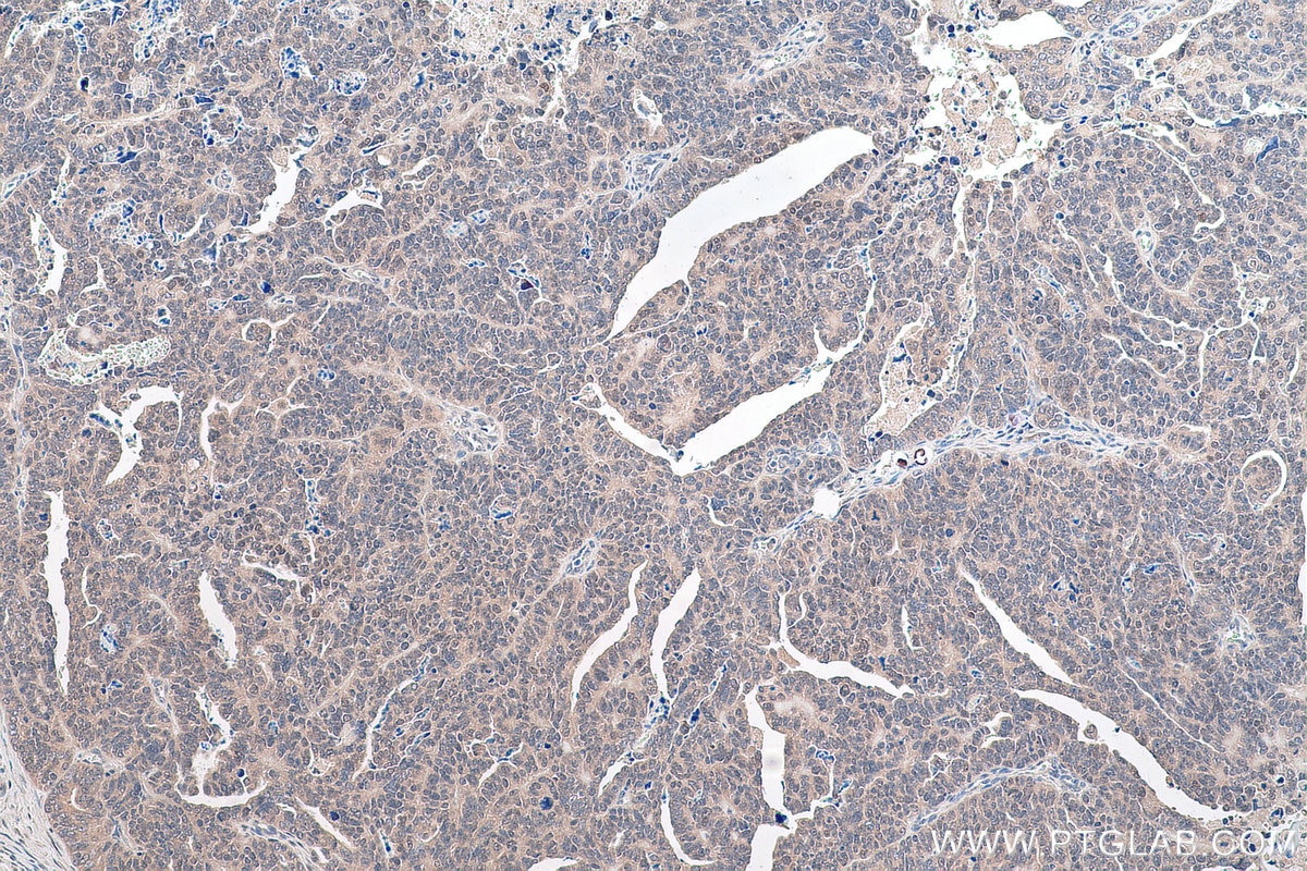 Immunohistochemical analysis of paraffin-embedded human ovary tumor tissue slide using KHC0901 (NEDD8 IHC Kit).