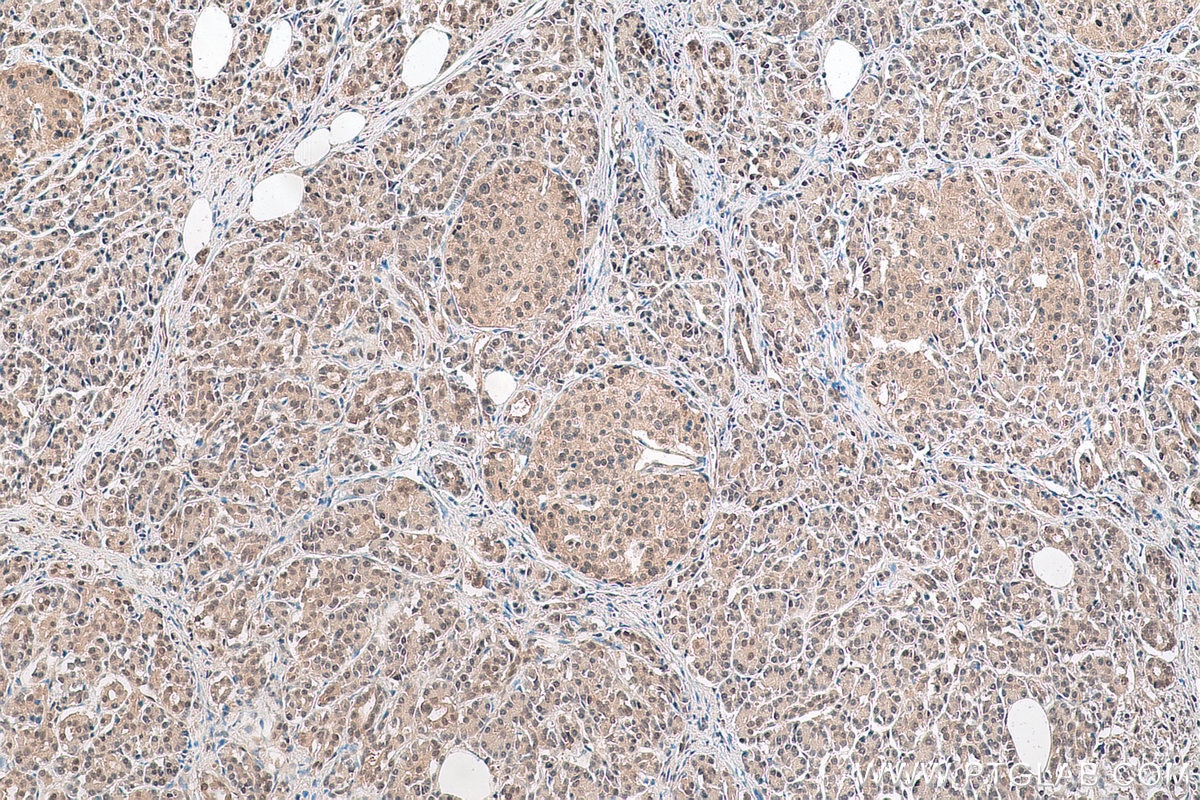 Immunohistochemical analysis of paraffin-embedded human pancreas cancer tissue slide using KHC0901 (NEDD8 IHC Kit).