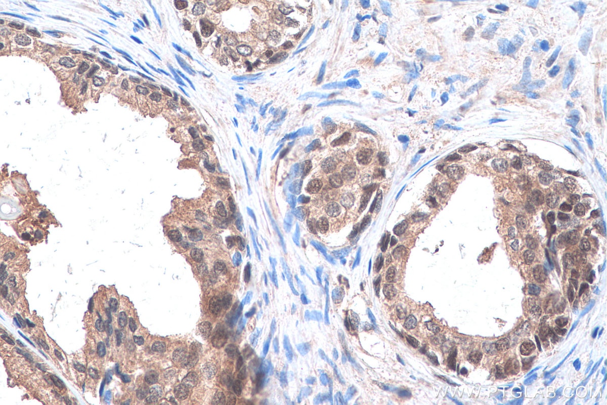 Immunohistochemical analysis of paraffin-embedded human prostate cancer tissue slide using KHC0901 (NEDD8 IHC Kit).