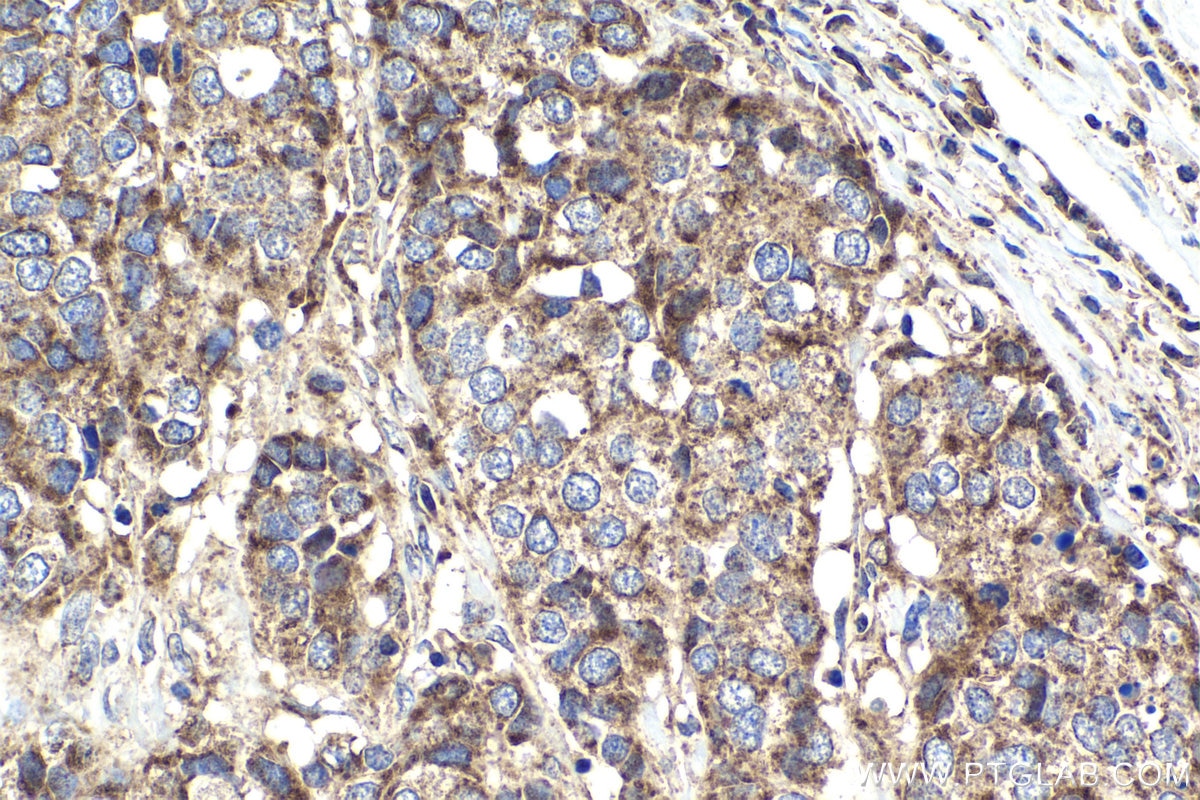 Immunohistochemical analysis of paraffin-embedded human stomach cancer tissue slide using KHC1945 (NEK6 IHC Kit).