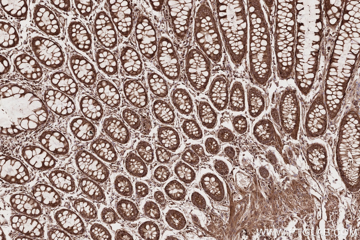 Immunohistochemical analysis of paraffin-embedded human rectal cancer tissue slide using KHC2716 (NEK9 IHC Kit).