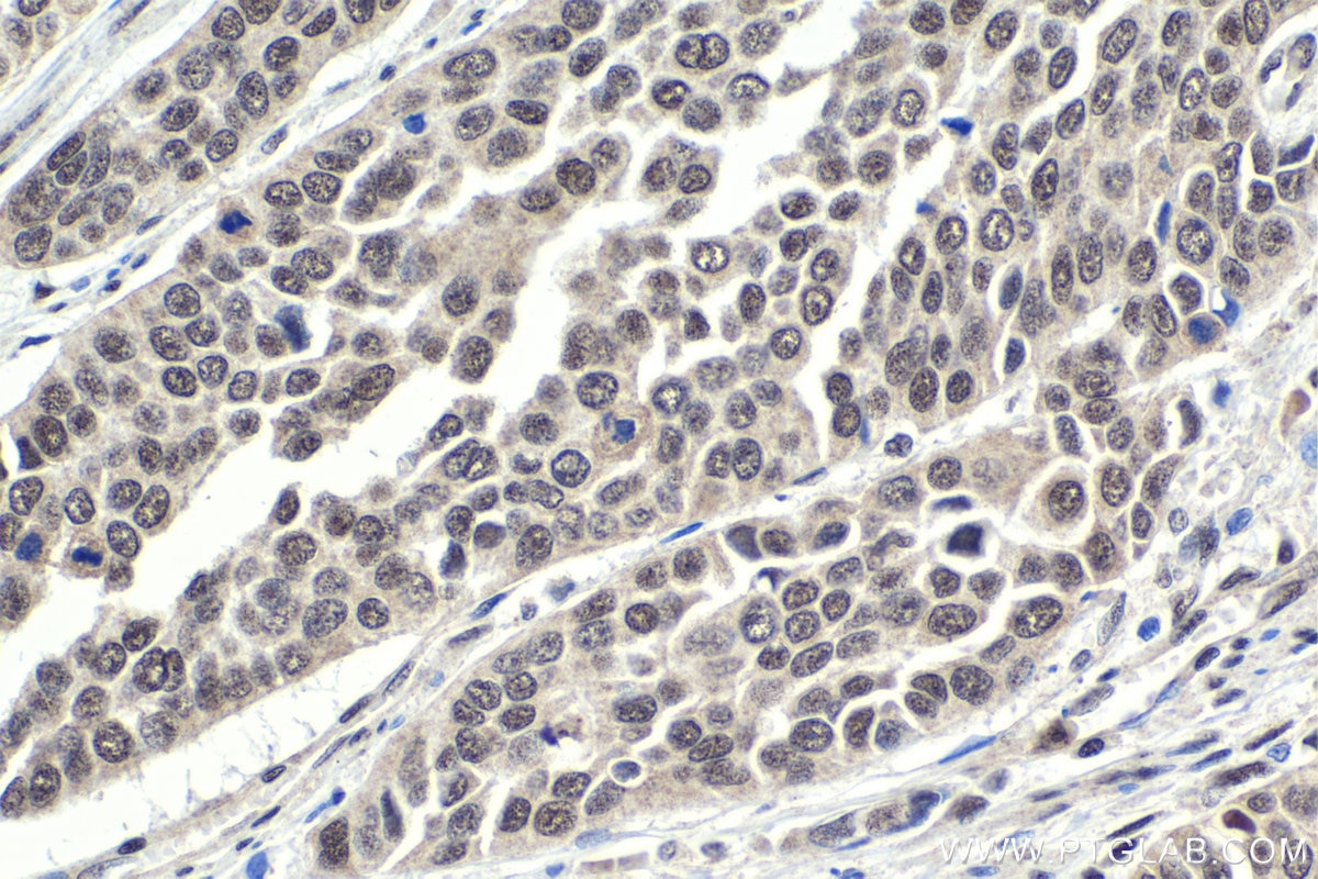 Immunohistochemical analysis of paraffin-embedded human oesophagus cancer tissue slide using KHC1845 (NELFB IHC Kit).