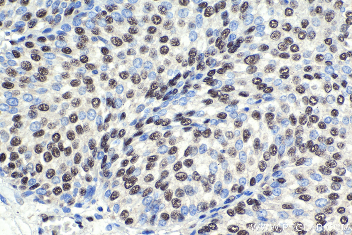 Immunohistochemical analysis of paraffin-embedded human urothelial carcinoma tissue slide using KHC1845 (NELFB IHC Kit).