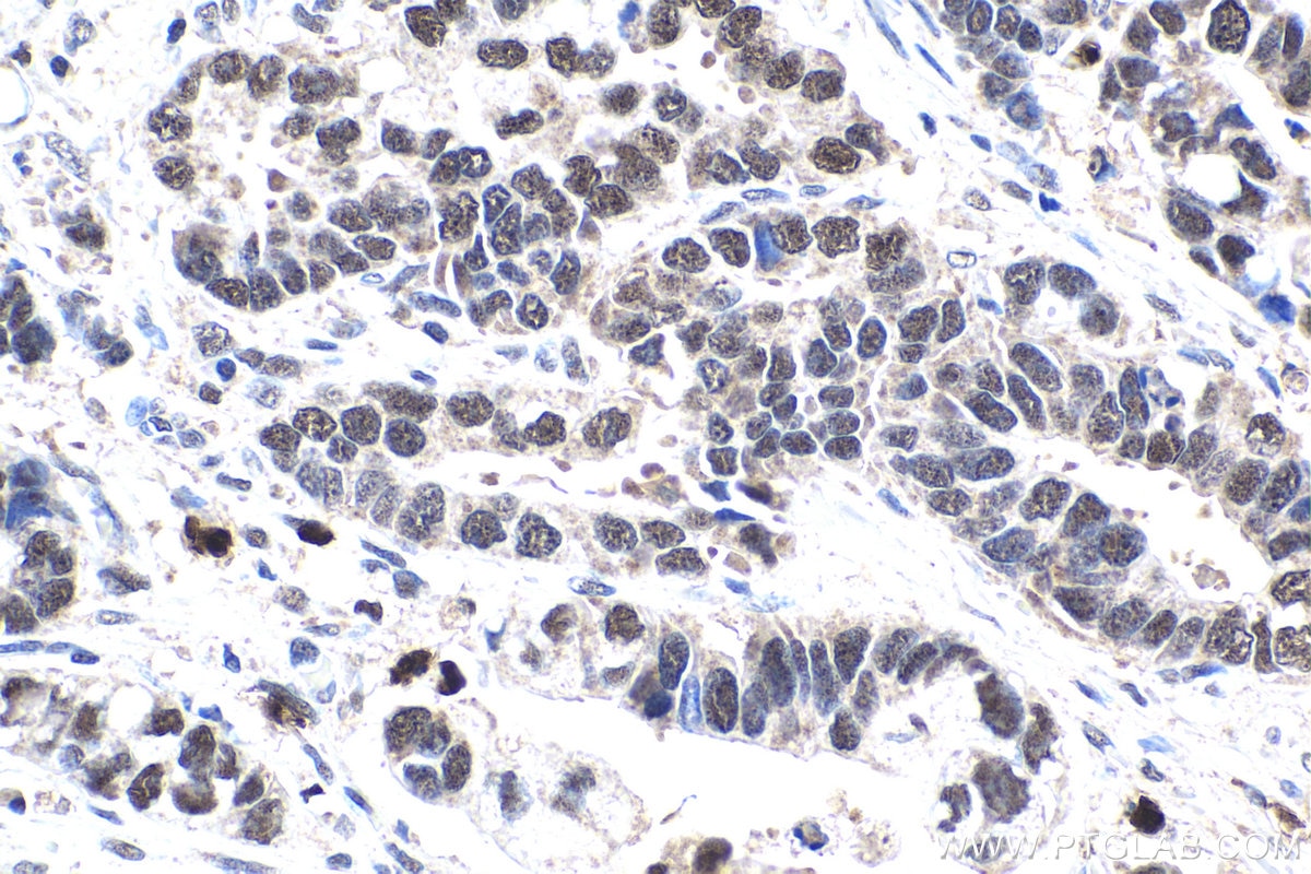 Immunohistochemical analysis of paraffin-embedded human stomach cancer tissue slide using KHC1820 (NELFCD/TH1L IHC Kit).
