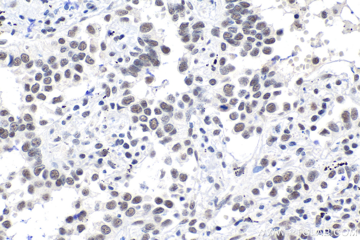 Immunohistochemical analysis of paraffin-embedded human lung cancer tissue slide using KHC1542 (NELFE IHC Kit).