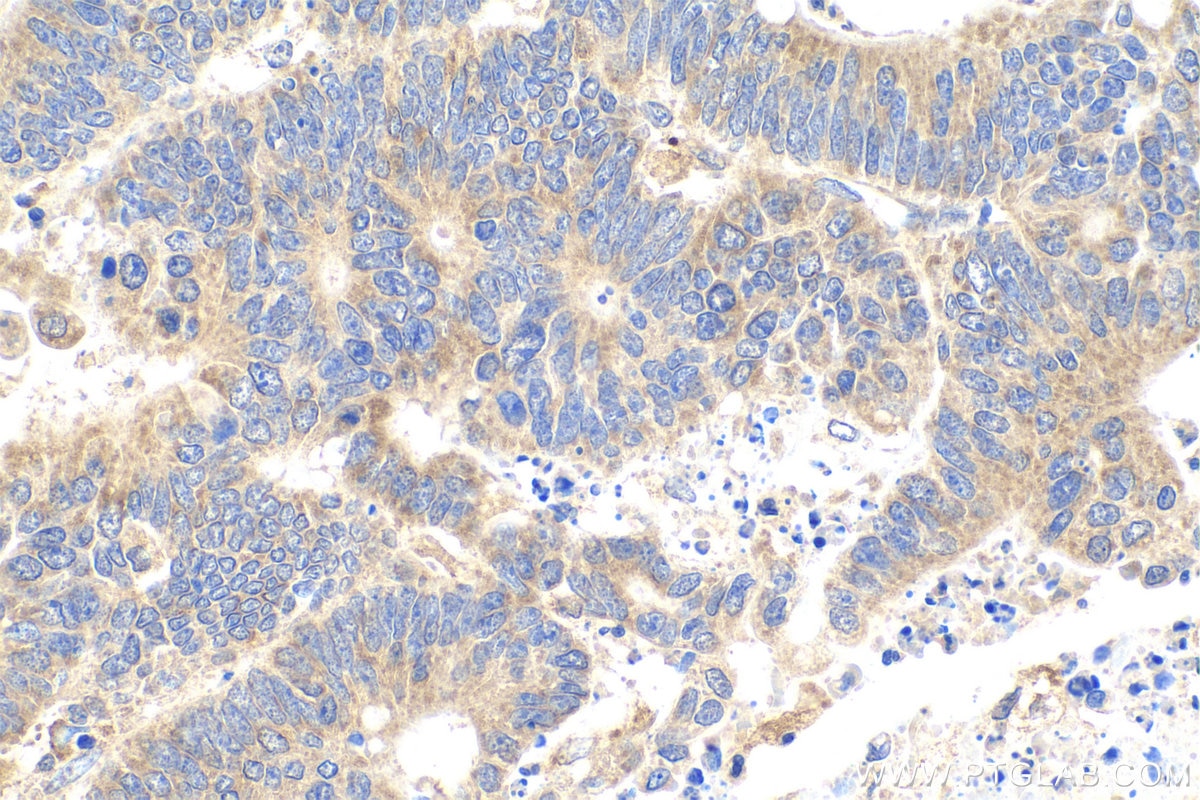 Immunohistochemical analysis of paraffin-embedded human colon cancer tissue slide using KHC0897 (NENF IHC Kit).