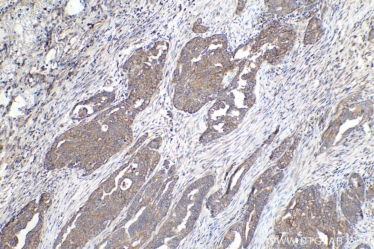 Immunohistochemical analysis of paraffin-embedded human ovary tumor tissue slide using KHC0897 (NENF IHC Kit).