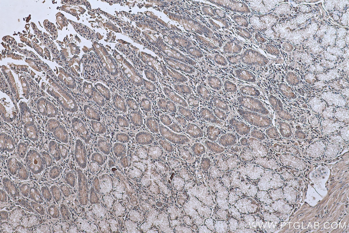 Immunohistochemical analysis of paraffin-embedded human stomach cancer tissue slide using KHC0634 (NF-κB p65 IHC Kit).