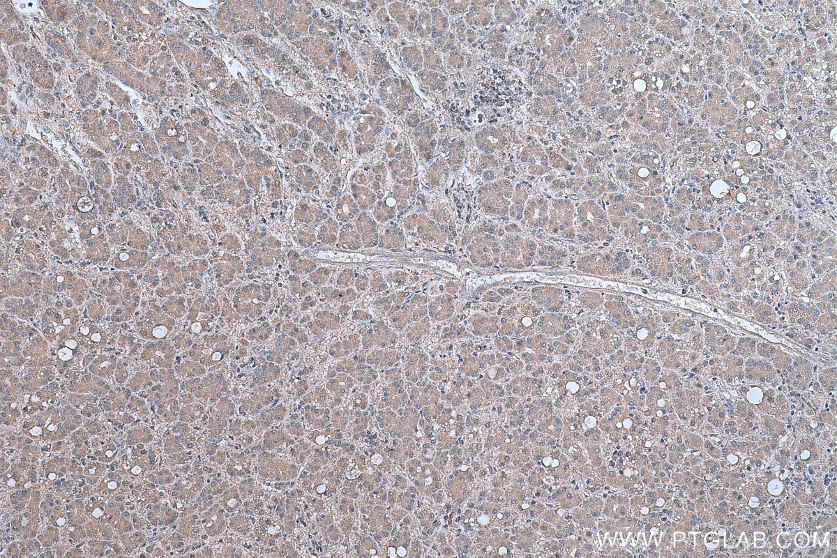 Immunohistochemical analysis of paraffin-embedded human liver cancer tissue slide using KHC0634 (NF-κB p65 IHC Kit).