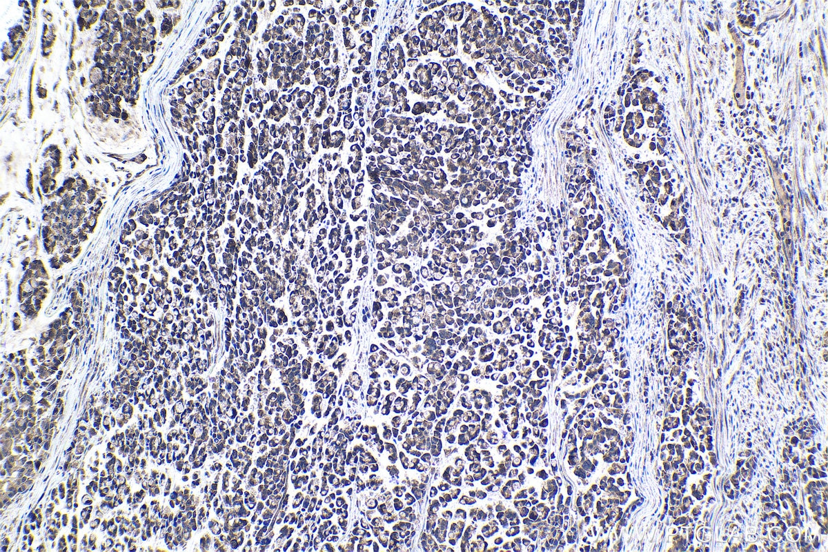 Immunohistochemical analysis of paraffin-embedded human colon cancer tissue slide using KHC1057 (NF1 IHC Kit).