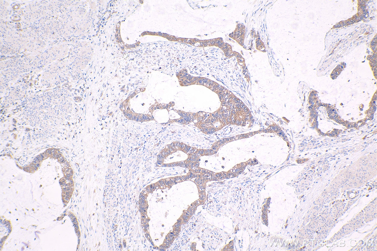 Immunohistochemical analysis of paraffin-embedded human urothelial carcinoma tissue slide using KHC1582 (NF2 IHC Kit).