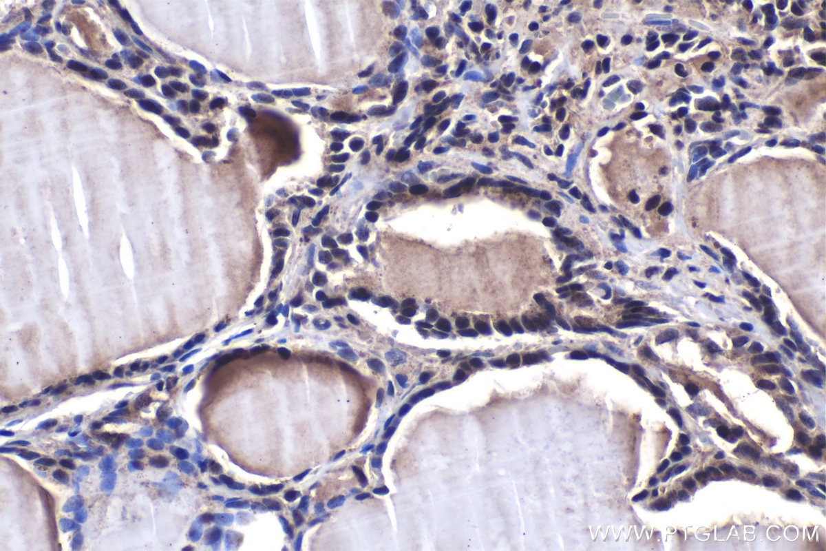 Immunohistochemical analysis of paraffin-embedded human thyroid cancer tissue slide using KHC1488 (NFAT5 IHC Kit).