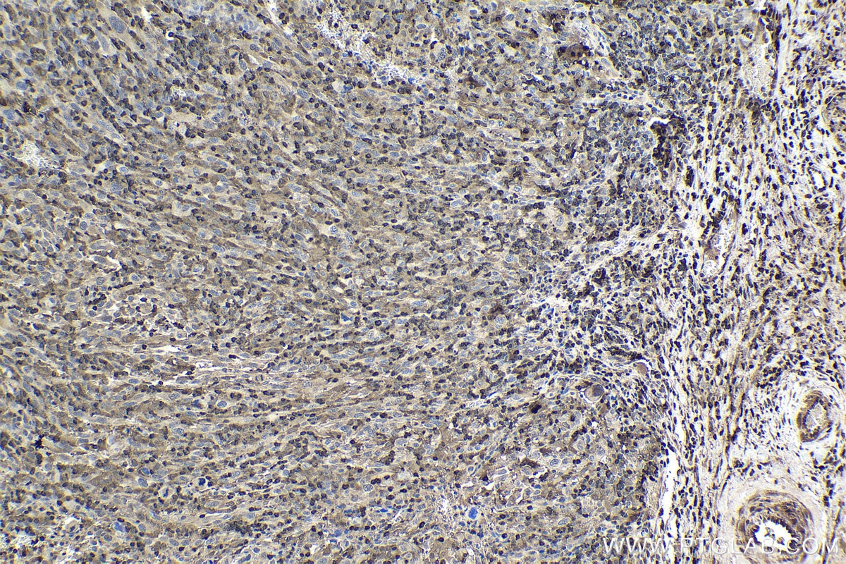 Immunohistochemical analysis of paraffin-embedded human skin cancer tissue slide using KHC1712 (NFATC2 IHC Kit).