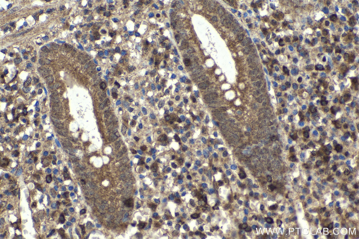 Immunohistochemical analysis of paraffin-embedded human appendicitis tissue slide using KHC1712 (NFATC2 IHC Kit).