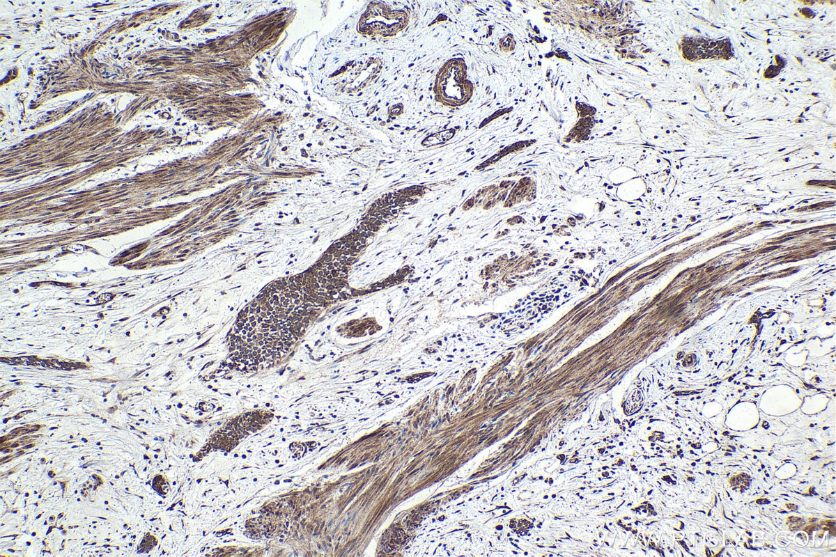 Immunohistochemical analysis of paraffin-embedded human urothelial carcinoma tissue slide using KHC1696 (NFATC3 IHC Kit).
