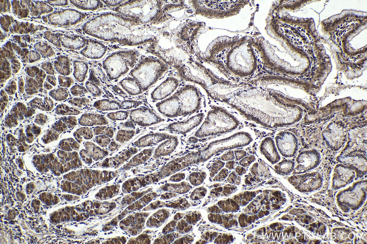 Immunohistochemical analysis of paraffin-embedded human stomach cancer tissue slide using KHC1696 (NFATC3 IHC Kit).