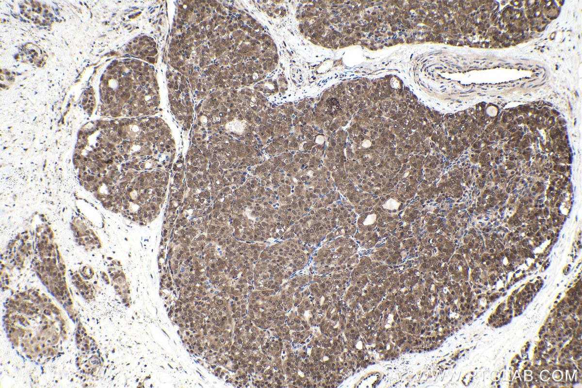 Immunohistochemical analysis of paraffin-embedded human thyroid cancer tissue slide using KHC1740 (NFATC4 IHC Kit).