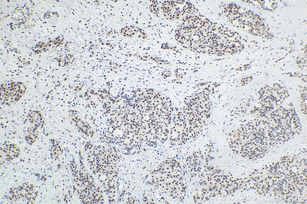 Immunohistochemical analysis of paraffin-embedded human thyroid cancer tissue slide using KHC1761 (NFE2 IHC Kit).