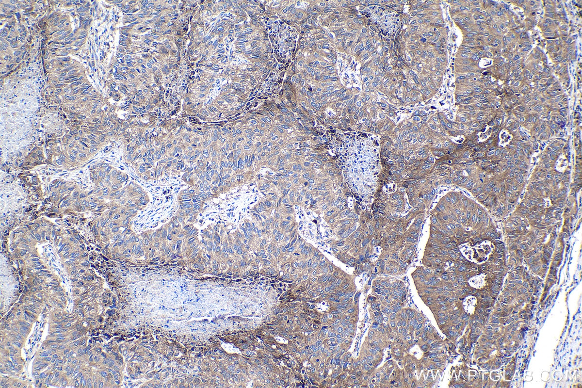 Immunohistochemical analysis of paraffin-embedded human lung cancer tissue slide using KHC1065 (NFE2L2/NRF2 IHC Kit).