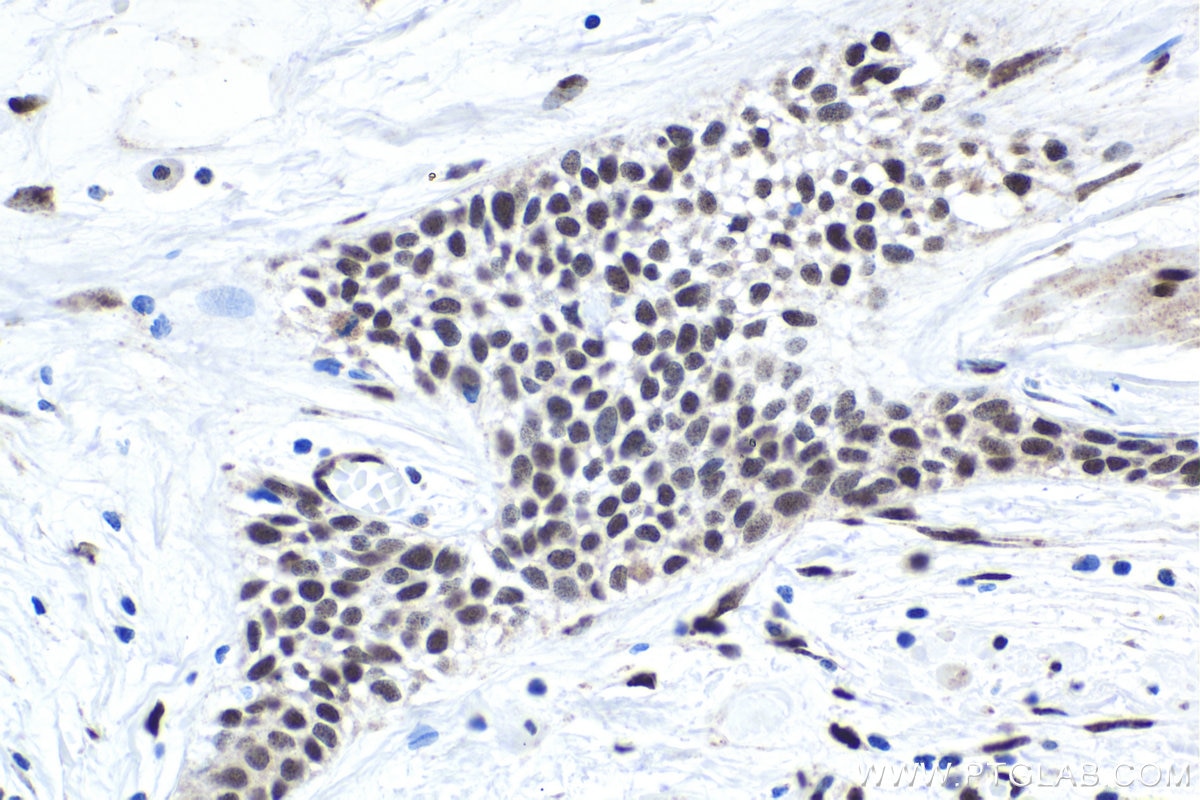 Immunohistochemical analysis of paraffin-embedded human urothelial carcinoma tissue slide using KHC1693 (NFIA IHC Kit).