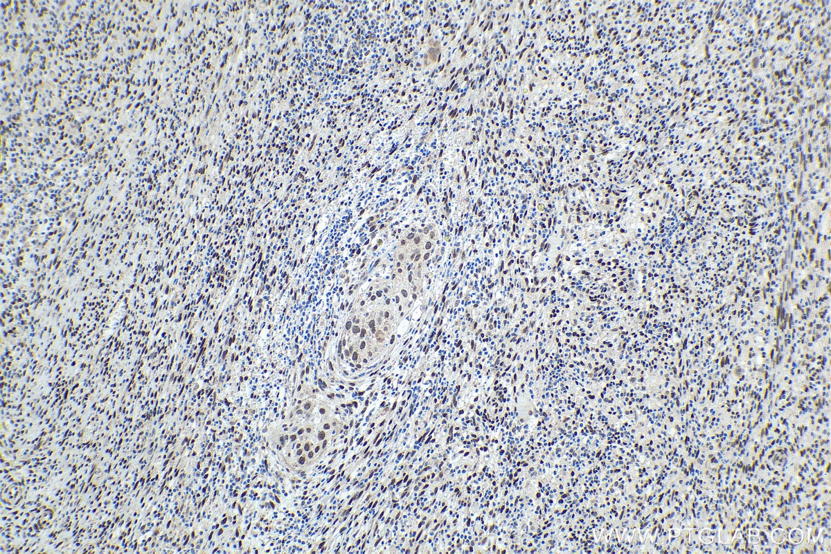 Immunohistochemical analysis of paraffin-embedded human cervical cancer tissue slide using KHC1693 (NFIA IHC Kit).
