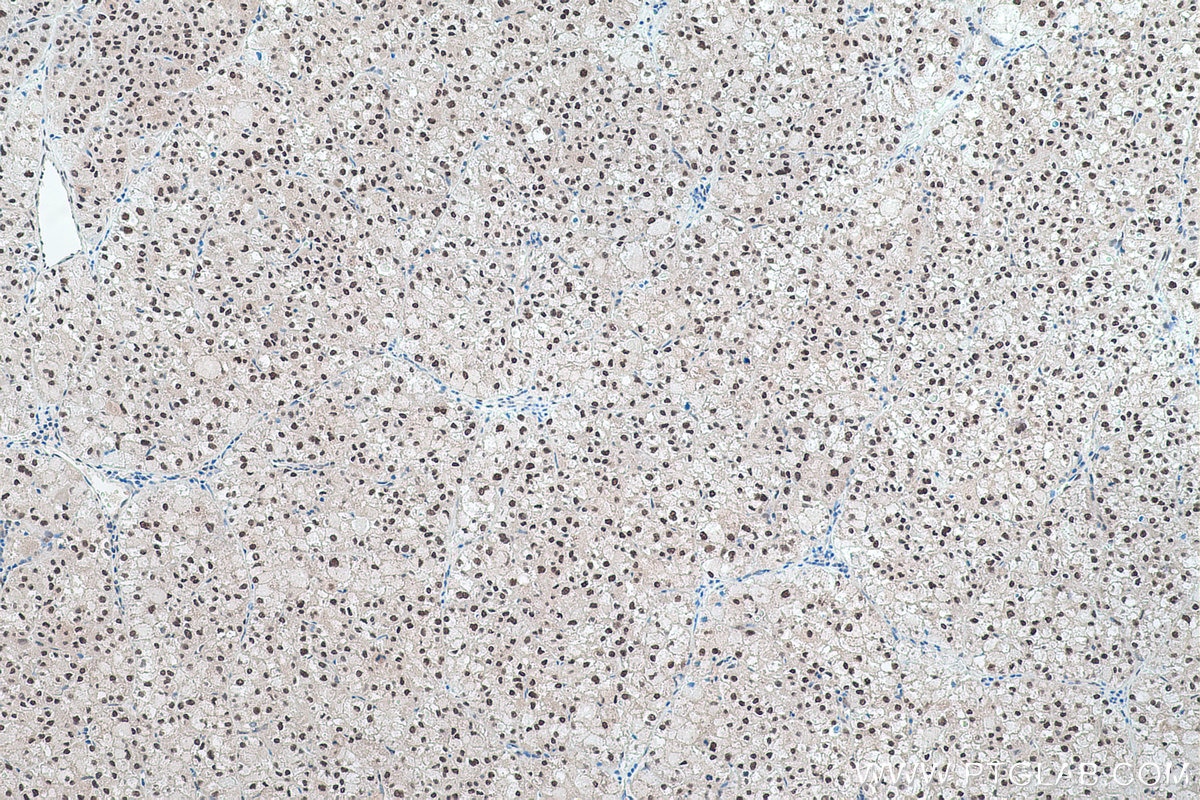 Immunohistochemical analysis of paraffin-embedded human liver cancer tissue slide using KHC0441 (NFIC IHC Kit).