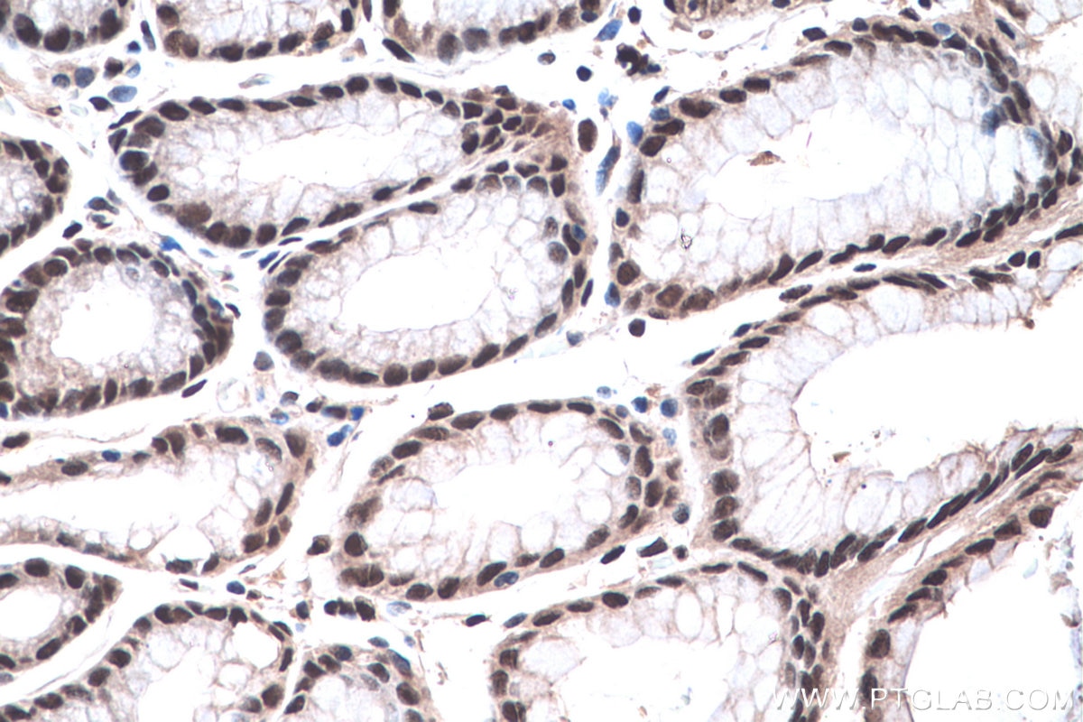 Immunohistochemical analysis of paraffin-embedded human stomach cancer(NAT) tissue slide using KHC0441 (NFIC IHC Kit).